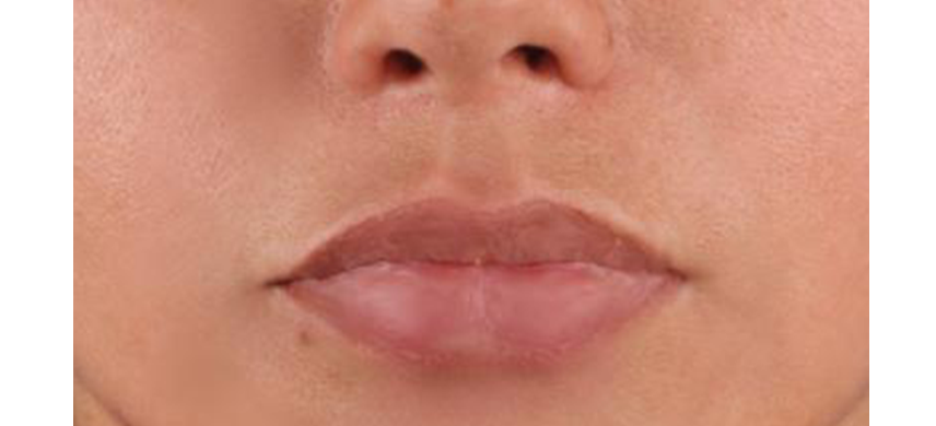 lip-lift-despues